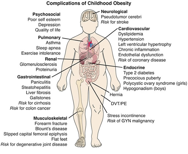 obesity childhood